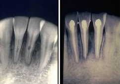 Endodoncia