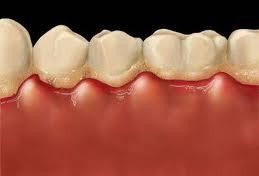 Periodontitis