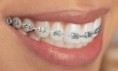/album/fotogaleria-preguntas-frecuentes/brackets-metalicos-jpg2/
